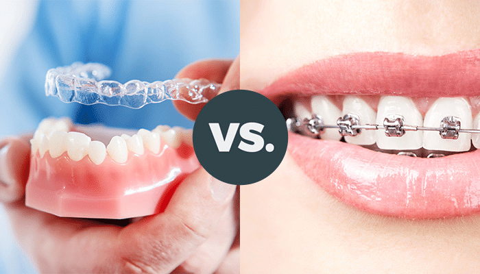 Braces Vs Aligners